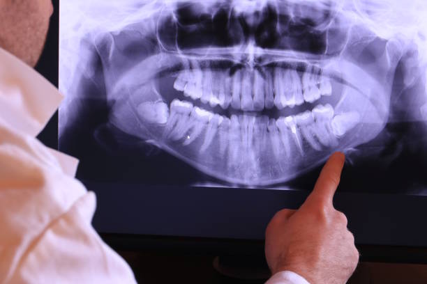 Best Emergency Wisdom Teeth Removal in Glencoe, MN
