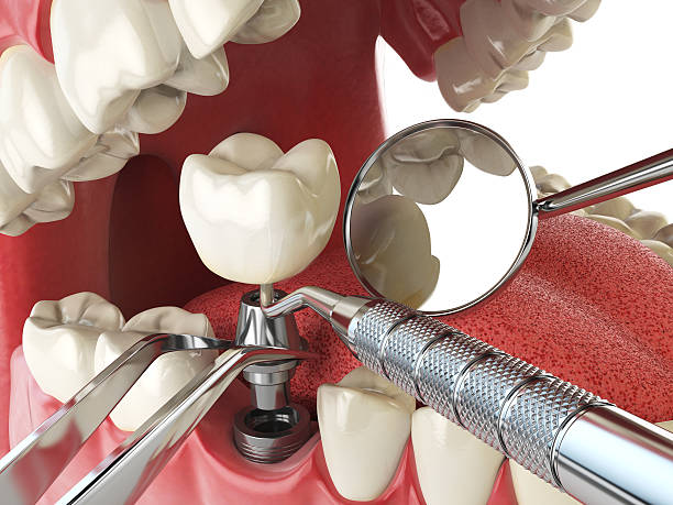 Best Emergency Tooth Extraction in Glencoe, MN